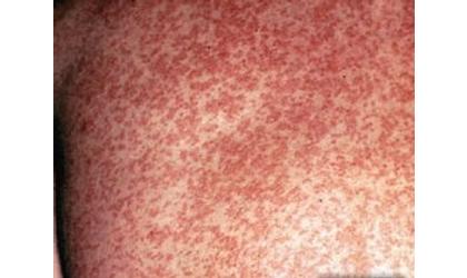Health officials confirm case of measles in Okmulgee County