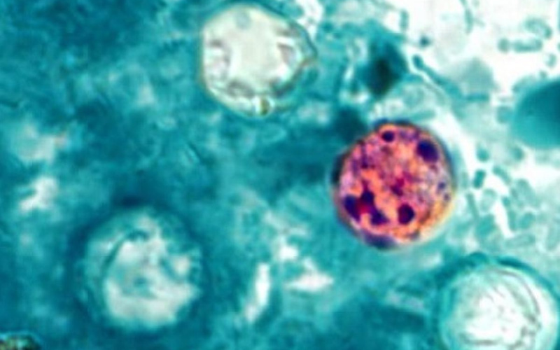Outbreak of diarrhea-causing parasite linked to 4 more states